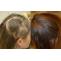 Does PRP Help Hair Grow? - Hair Transplant Dubai Clinic