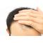 Does PRP stop hair fall? &#8211; Hair Transplant Clinic Dubai