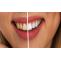 Natural Teeth Whitening Tips for Stained or Yellow Teeth