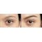 Eyebrow Hair Transplantation in Tirupati - Dr.Sajjas.in