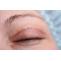 Best Eyelid Surgery in India | Healing Touristry