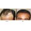 Automated FUE Hair Transplant in Dubai, UAE | Hair Transplant Dubai