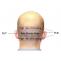 Hair Transplant in Delhi | Hair Transplant Cost in Delhi NCR