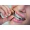 Dental implants in Southwest Ranches