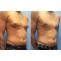 Top Gynecomastia Surgery in Pune, PCMC - Dr. Shilpy Dolas