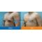 Gynecomastia Surgery in Pune | Male Breast Reduction Surgery in Pune