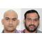 Cost of Hair Transplant