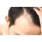 Best Hair Transplant in Dubai, UAE Clinic - Dynamic Hair Transplant