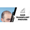 How does the hair transplant process perform?