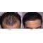 No Shedding after Hair Transplant | Hair Transplant Dubai