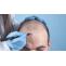 Best Hair Transplant in Delhi