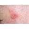 Herbal Treatment for Lichen Planus and Its Promising Solution - Herbal Care Products - Blog