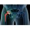 Hip Replacement Treatment with Artificial Implantation