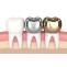 How Long Do Dental Crowns Last?