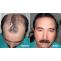 FUE Hair Transplant in Islamabad 