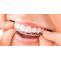 Best Dental Implants in Las Vegas by Urgent Dental