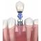 Dental Implants in Albuquerque, NM | Uptown Dental Associates