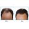 Best hair transplant clinics in Chandigarh | Hair-transplant