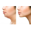 What to Know About Kybella Treatment