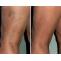  Laser Thread Vein Removal Treatment in India | Healing Touristry