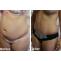 Laser Lipo South Africa