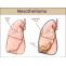 Learn About Mesothelioma and Get the Help You Deserve