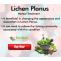 Herbal Care Products: Natural Remedies for Lichen Planus and Foods to Avoid