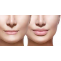 Lip Augmentation - Enhance Your Lips For a Full Young Smile