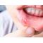 Ayurvedic Treatment for Mouth Ulcers |