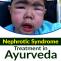 Nephrotic Syndrome Treatment in Ayurveda