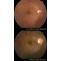 Diabetic Retinopathy