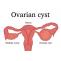 Natural Treatment for Ovarian Cyst - Causes, Types, Symptoms &amp; Health Tips |