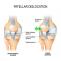 Dislocación de la Rótulam, Patella Dislocation Surgery | Siiora.mx