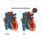 Patent Ductus Arteriosus