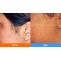 laser hair removal in Pune | Karishma Cosmetic | Hair removal