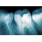 Tooth implants surgery bellevue  -  Oral implants bellevue