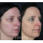 The Vampire Facial PRP Therapy for Facial Rejuvenation 