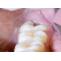Management of Pericoronitis using Dental Diode Laser
