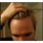 High Hairline in Teenage Male | Hair Transplant Dubai