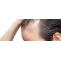 Receding hairline? Here is how to restore it effectively | Hair Transplant Dubai