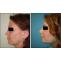 Best Rhinoplasty Surgeon in Gurgaon | Nose Reshaping Surgery in Gurgaon