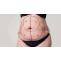 What Is the Difference Between A Tummy Tuck and Abdominoplasty?