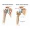 Shoulder Replacement in Chennai-Prime Shoulder