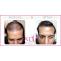 Artificial hair transplant and replacement procedure cost in India