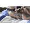 Permanent Tattoo Removal | Tattoo Removal in Tirupati