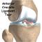 ACL (Anterior Cruciate Ligament) Reconstruction Surgery |  Dr. Siddharth Aggarwal | Golden Hospital