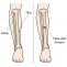 Treatment of The Fractures of The Tibia - Exactarticle : Exactarticle