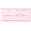 What is Tachycardia? Symptoms and Causes | Dr Raghu