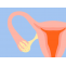 Poor Ovarian Reserve and Infertility - What Need to Know