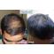 #1 Best LLLT Treatment for Hairfall in Durgapur